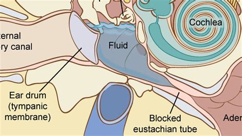 reduce fluid   ear tomrelation