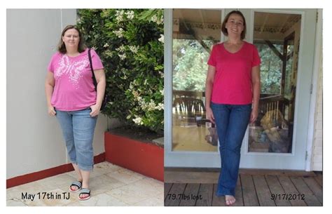 Tijuana Gastric Sleeve Surgery Before And After Photos Patient Success