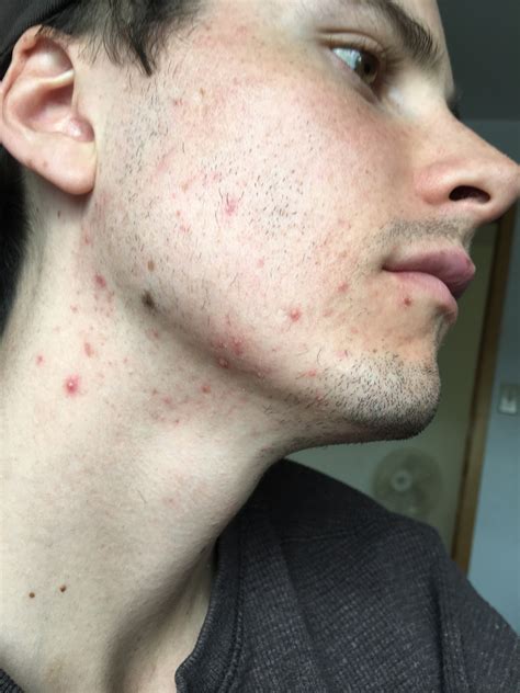 male hormonal acne help tried everything hormonal acne by
