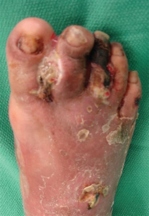 A Clinical Presentation Of A Severe Diabetic Foot Infec