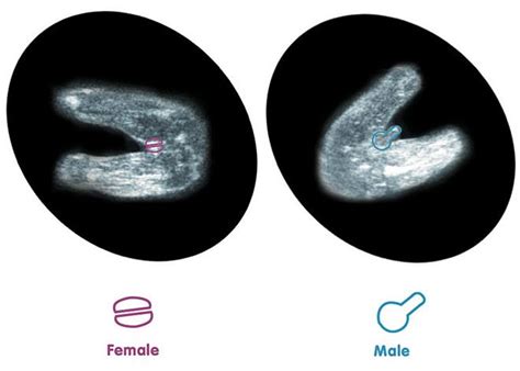 12 haftalık erkek bebek ultrason görüntüleri nasıldır mavi kadın