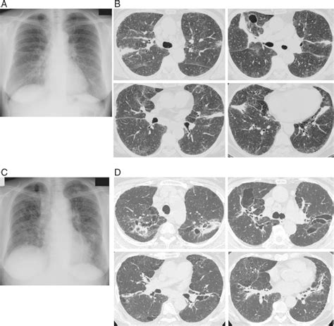 Chest X‐ray In January 2002 Showed Stage Ii Bilateral Hilar