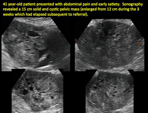 imaging the suspected ovarian malignancy 14 cases mdedge obgyn