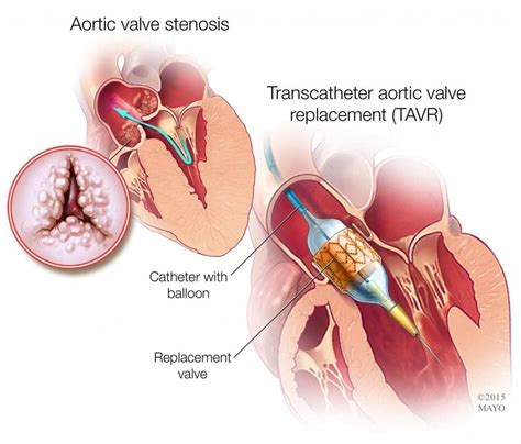 Mayo Clinic Q And A Mild To Moderate Aortic Stenosis Typically Doesn’t