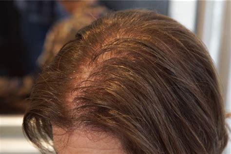 age women lose  hair   treatments  work