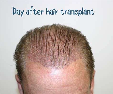 important steps  follow   hair transplant