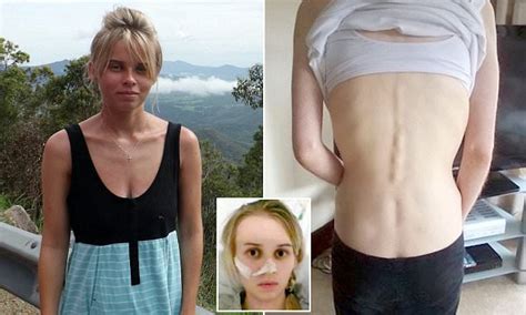 anorexic fears food so much she believes calories can be
