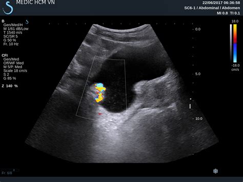 vietnamese medic ultrasound case  urinary bladder tumor dr phan