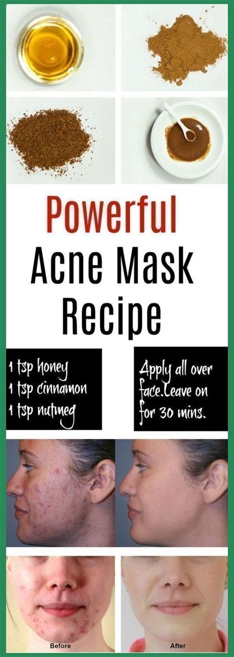 best way to get rid of acne overnight find out how to