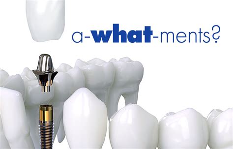 dental implant abutment sirakian aesthetic implant dentistry blog