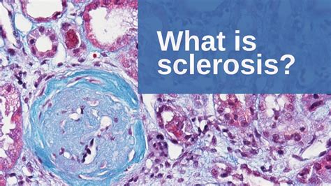 sclerosis pathology mini tutorial youtube