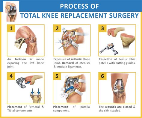 We Can Heal Your Osteoarthritic Knees No Matter How Bad