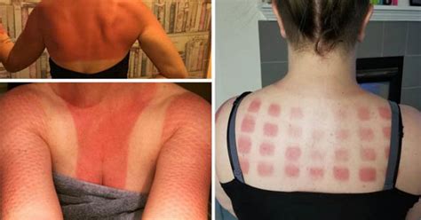 Worst Sunburns Ever Hilarious Snaps Of People With Their Very Awkward
