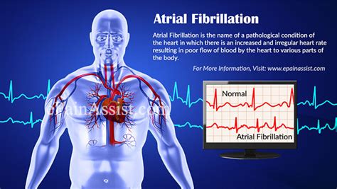 Causes Of Atrial Fibrillation What Is Nonvalvular Atrial Fibrillation