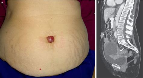 A Lump Grew Out Of A Woman S Belly Button It Was Cancer Live Science