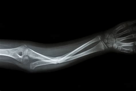 Broken Arm Bones X Ray