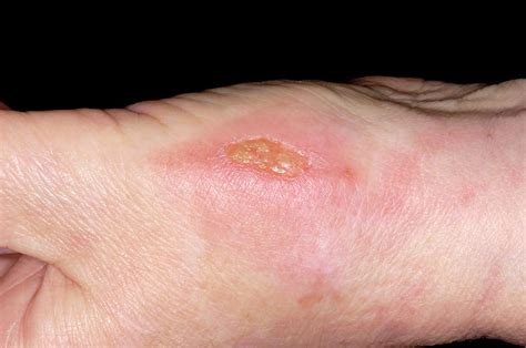 infected burn photograph  dr p marazziscience photo library