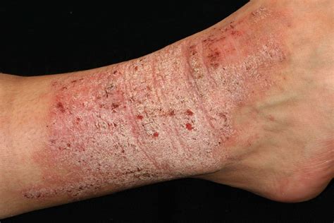 lichen simplex chronicus and eczema