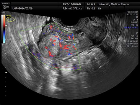 diagnosis and management of an adenomatoid uterine tumor ultrasound