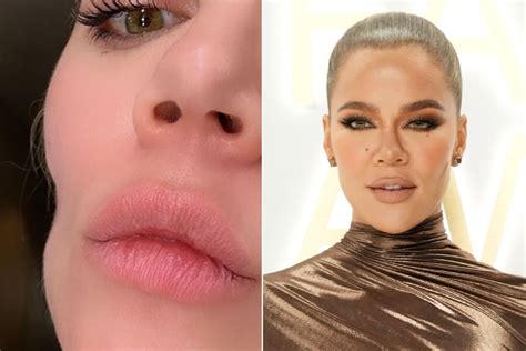 khloé kardashian opens up about cheek indentation left by melanoma