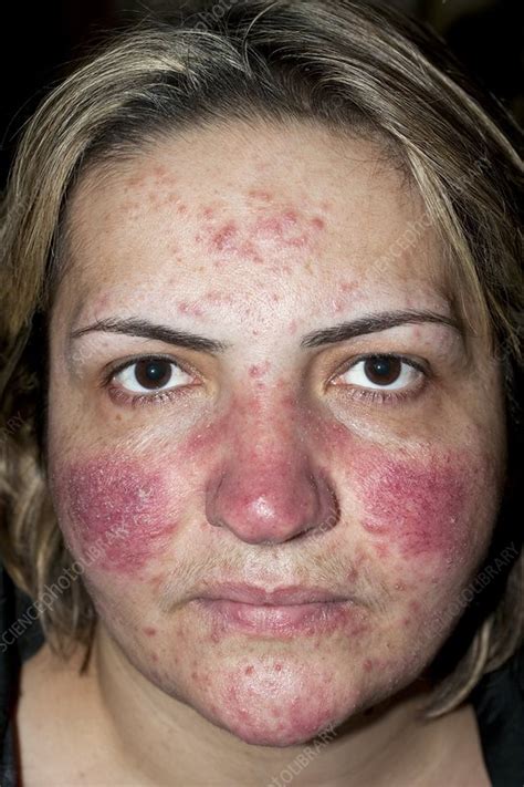 acne rosacea stock image  science photo library