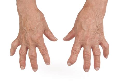 common arthritis symptoms   hands