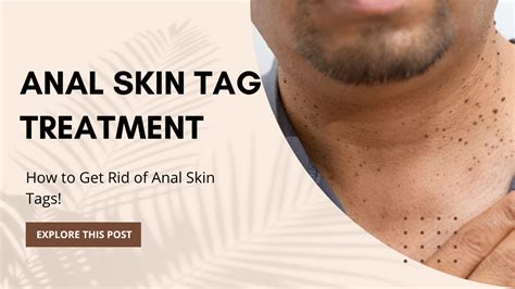how to get rid of anal skin tags
