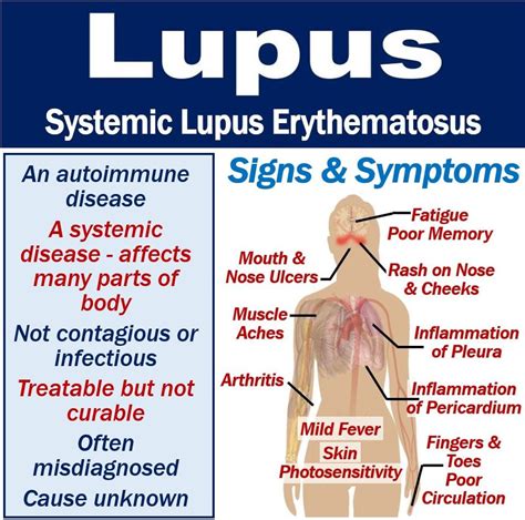 lupus symptoms  diagnosis  treatment mbn health