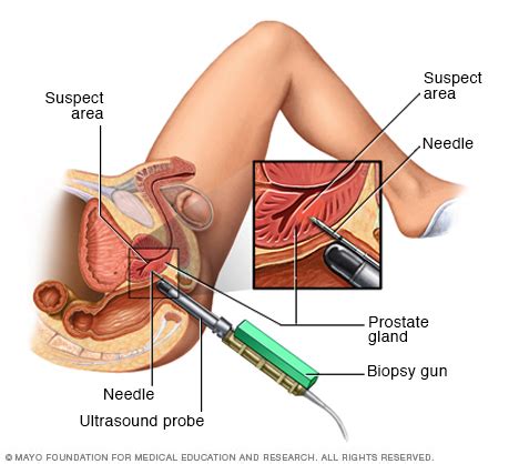 Sexual stimulation during colonoscopy
