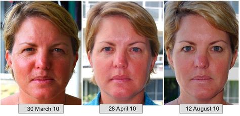 ageloc galvanic spa  months treating face skin facial yoga