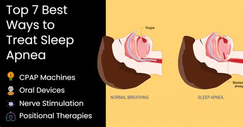 devices  sleep apnea heres  works   cpapcom blog