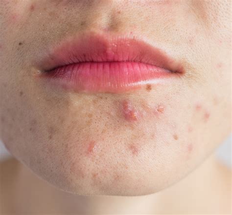 acne rosacea dermatology australasia