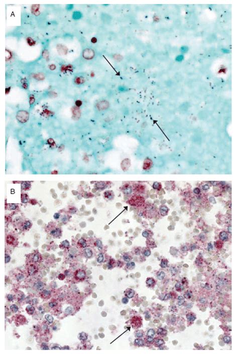 Bacterial Coinfections In Lung Tissue Specimens From Fatal