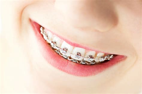 metal braces orthodontics manchester