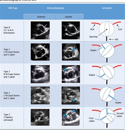 [pdf] Prognostic Implications Of Raphe In Bicuspid Aortic Valve Anatomy