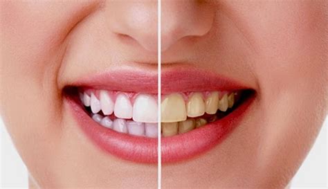 tips memutihkan gigi kuning secara alami tips tricks