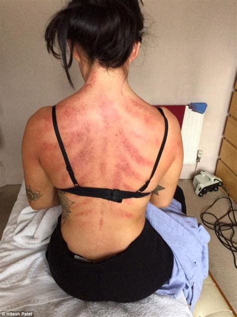 man is left with horrific marks after massage session