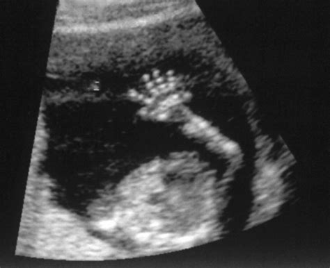 Sex of baby ultrasounds