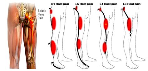 acupressure points  sciatica leg pain  acupuncture works