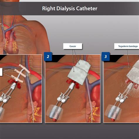 right dialysis catheter trialexhibits inc