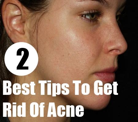 rid  acne fast overnight  home remedies