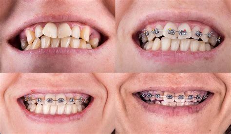 braces istanbul dental care