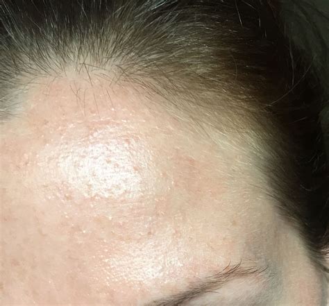 Small Rash Like Bumps All Over Face Beauty Insider Community