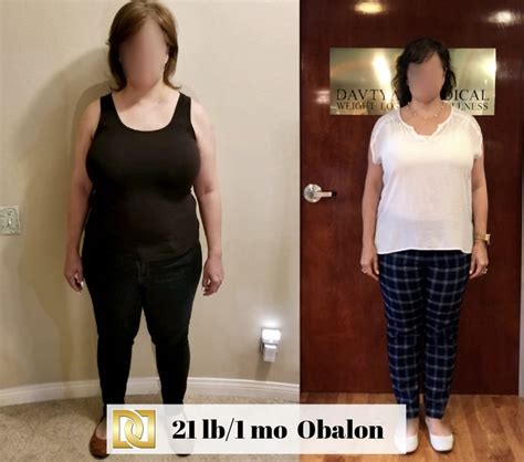 Bariatric Surgery Before After With Obalon Gastric Balloon
