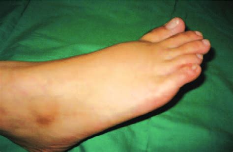 Swelling Over Dorsum Of Right Foot Download Scientific