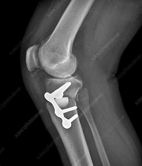 Knee Realignment Surgery X Ray Stock Image C016 6602