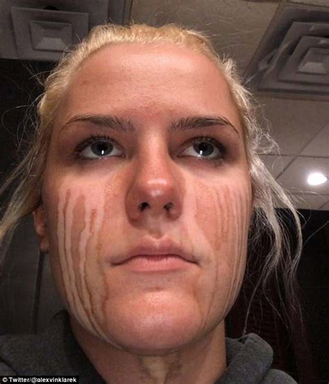 Woman Cried After Applying Fake Tan And Is Left With Streaks Daily