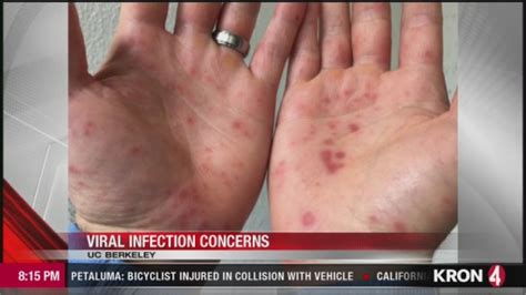 video hand foot and mouth disease pops up at three us college campuses