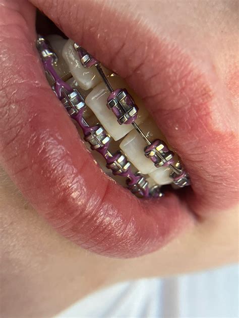 adult braces dental braces teeth braces cute braces colors pretty