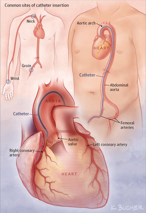 cardiac catheterization cardiology jama jama network